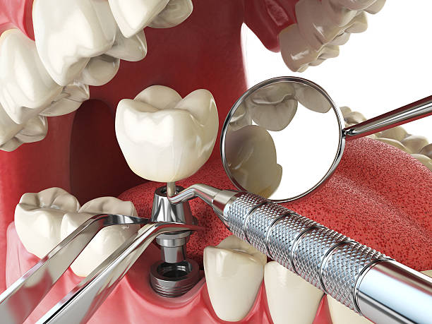 Best Emergency Root Canal Treatment in Gananda, NY